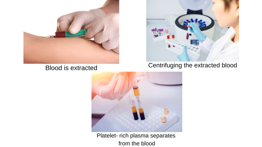 prp Process