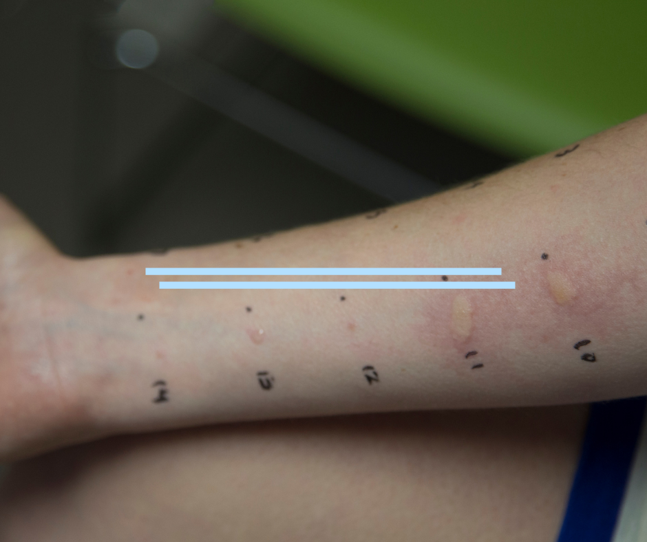 allergy skin test